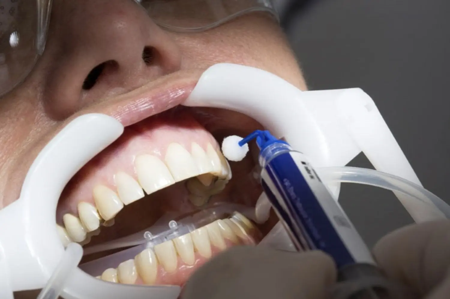 Dentcoat von Zahnarztpraxis Bergmann 